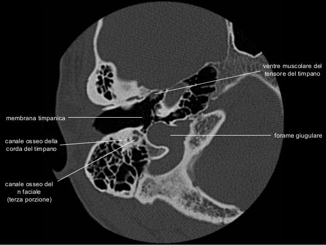 Anatomia Rocca TC - CT temporal bone anatomy