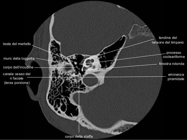 Anatomia Rocca TC - CT temporal bone anatomy
