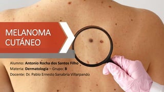MELANOMA
CUTÁNEO
Alumno: Antonio Rocha dos Santos Filho
Materia: Dermatología – Grupo: B
Docente: Dr. Pablo Ernesto Sanabria Villarpando
 