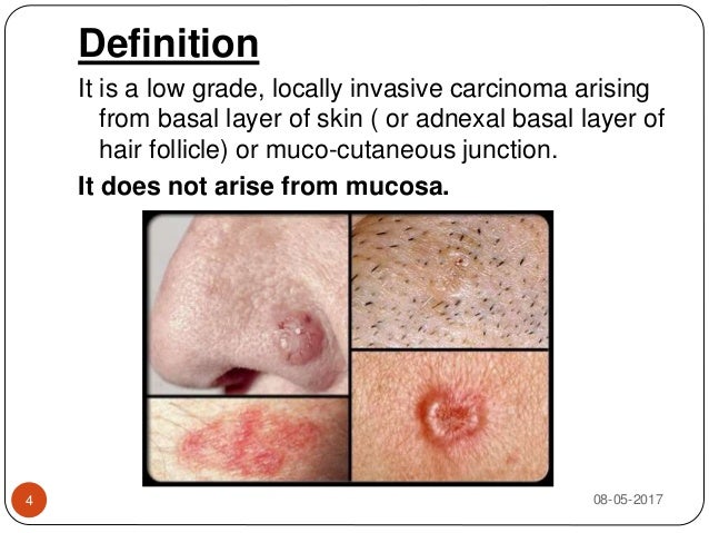Rodent Ulcer rodent-ulcer