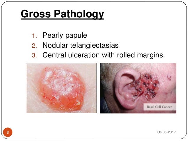Rodent Ulcer rodent-ulcer
