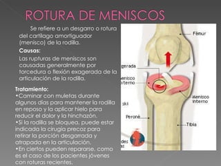 Se refiere a un desgarro o rotura del cartílago amortiguador (menisco) de la rodilla. Causas: Las rupturas de meniscos son causadas generalmente por torcedura o flexión exagerada de la articulación de la rodilla. Tratamiento: Caminar con muletas durante algunos días para mantener la rodilla en reposo y la aplicar hielo para reducir el dolor y la hinchazón. Si la rodilla se bloquea, puede estar indicada la cirugía precoz para retirar la porción desgarrada y atrapada en la articulación.  En ciertos pueden repararse, como es el caso de los pacientes jóvenes con roturas recientes.  