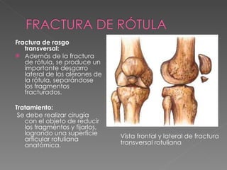 Fractura de rasgo transversal:   Además de la fractura de rótula, se produce un importante desgarro lateral de los alerones de la rótula, separándose los fragmentos fracturados. Tratamiento: Se debe realizar cirugía con el objeto de reducir los fragmentos y fijarlos, logrando una superficie articular rotuliana anatómica.  Vista frontal y lateral de fractura transversal rotuliana 