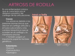 Es una enfermedad crónica que se caracteriza por el deterioro paulatino del cartílago de las articulaciones.  Causas La artrosis es debida a las presiones biomecánicas que afectan el cartílago articular y el hueso subcondral y a los cambios bioquímicos que se suceden en el cartílago y la membrana sinovial. También juegan un importante papel los factores genéticos. Tratamiento: Natural Farmacéutico Quirúrgico 