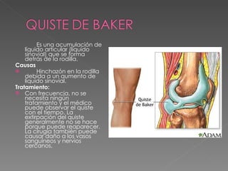 Es una acumulación de líquido articular (líquido sinovial) que se forma detrás de la rodilla. Causas Hinchazón en la rodilla debida a un aumento de  líquido sinovial.  Tratamiento: Con frecuencia, no se necesita ningún tratamiento y el médico puede observar el quiste con el tiempo. La extirpación del quiste generalmente no se hace porque puede reaparecer. La cirugía también puede causar daño a los vasos sanguíneos y nervios cercanos. 