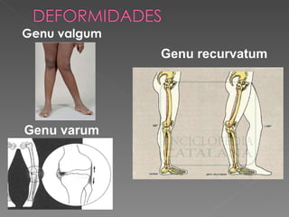 Genu valgum Genu recurvatum Genu varum 