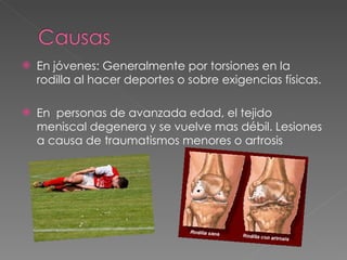 En jóvenes: Generalmente por torsiones en la rodilla al hacer deportes o sobre exigencias físicas. En  personas de avanzada edad, el tejido meniscal degenera y se vuelve mas débil. Lesiones a causa de traumatismos menores o artrosis 