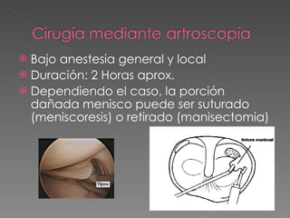 Bajo anestesia general y local Duración: 2 Horas aprox. Dependiendo el caso, la porción dañada menisco puede ser suturado (meniscoresis) o retirado (manisectomia) 