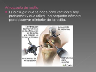 Artroscopia de rodilla Es la cirugía que se hace para verificar si hay problemas y que utiliza una pequeña cámara para observar el interior de la rodilla. 