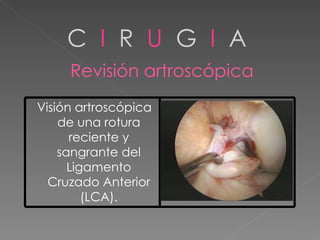 C  I   R  U   G  I  A Revisión artroscópica Visión artroscópica de una rotura reciente y sangrante del Ligamento Cruzado Anterior (LCA). 