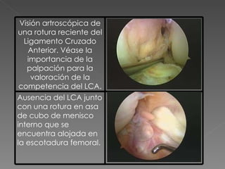 Visión artroscópica de una rotura reciente del Ligamento Cruzado Anterior. Véase la importancia de la palpación para la valoración de la competencia del LCA. Ausencia del LCA junto con una rotura en asa de cubo de menisco interno que se encuentra alojada en la escotadura femoral. 