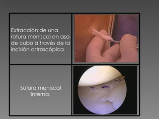 Extracción de una rotura meniscal en asa de cubo a través de la incisión artroscópica Sutura meniscal interna. 