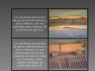 Los tendones de la pata de ganso (semitendinoso y recto interno) una vez extraídos para utilizarse en la sustitución del LCA. Los tendones de la pata de ganso (semitendinoso y recto interno) una vez preparados (tensados, mientras se suturan) para ser insertados como plastia autóloga de sustitución del LCA. 