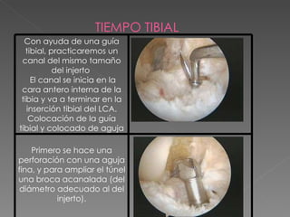 TIEMPO TIBIAL Con ayuda de una guía tibial, practicaremos un canal del mismo tamaño del injerto  El canal se inicia en la cara antero interna de la tibia y va a terminar en la inserción tibial del LCA. Colocación de la guía tibial y colocado de aguja Primero se hace una perforación con una aguja fina, y para ampliar el túnel una broca acanalada (del diámetro adecuado al del injerto). 