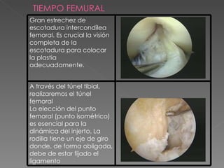 TIEMPO FEMURAL Gran estrechez de escotadura intercondílea femoral. Es crucial l a visión completa de la escotadura para colocar la plastia adecuadamente. A través del túnel tibial, realizaremos el túnel femoral La elección del punto femoral  (punto isométrico) es esencial para la dinámica del injerto. La rodilla tiene un eje de giro donde, de forma obligada, debe de estar fijado el ligamento 