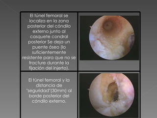 El túnel femoral  se localiza en la zona posterior del cóndilo externo junto al casquete condral posterior Se deja un puente óseo (lo suficientemente resistente para que no se fracture durante la fijación del injerto). El túnel femoral y la distancia de "seguridad"(30mm) al borde posterior del cóndilo externo. 