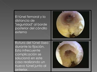 El túnel femoral y la distancia de "seguridad" al borde posterior del cóndilo externo Rotura del túnel óseo durante la fijación. Esta infrecuente complicación se solucionó en este caso realizando un nuevo túnel junto al anterior. 