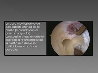 Un caso muy ilustrativo de colocación errónea de la plastia (marcada con el gancho palpador).  La excesiva situación anterior provocó la rotura precoz de la plastia que debió ser sustituida en la posición correcta. 