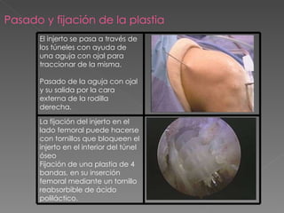 Pasado y fijación de la plastia El injerto se pasa a través de los túneles con ayuda de una aguja con ojal para traccionar de la misma. Pasado de la aguja con ojal y su salida por la cara externa de la rodilla derecha. La fijación del injerto en el lado femoral puede hacerse con tornillos que bloqueen el injerto en el interior del túnel óseo Fijación de una plastia de 4 bandas, en su inserción femoral mediante un tornillo reabsorbible de ácido poliláctico. 