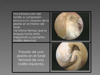 La introducción del tornillo a compresión provoca un cloqueo de la plastia en el interior del túnel al mismo tiempo que la empuja hacia atrás mejorando su isometría (rodilla derecha). Pasado de una plastia en el túnel femoral de una rodilla izquierda. 