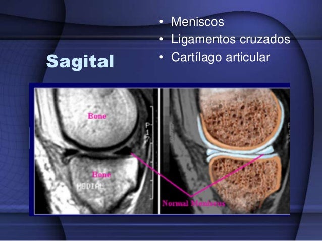 resonancia magnetica rodilla con contraste resonancia magnetica rodilla con contraste