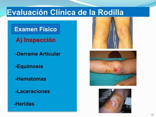 Evaluación Clínica de la Rodilla
Examen Físico
A) Inspección
-Derrame Articular
-Equimosis
-Hematomas
-Laceraciones
-Heridas

 