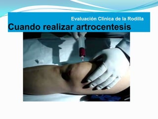 Evaluación Clínica de la Rodilla

Cuando realizar artrocentesis

 