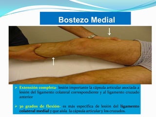 Bostezo Medial

 Extensión completa- lesión importante la cápsula articular asociada a
lesión del ligamento colateral correspondiente y al ligamento cruzado
anterior
 30 grados de flexión- es más específica de lesión del ligamento
colateral medial y que aísla la cápsula articular y los cruzados.

 