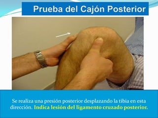 Se realiza una presión posterior desplazando la tibia en esta
dirección. Indica lesión del ligamento cruzado posterior.

 