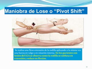 Maniobra de Lose o “Pivot Shift”

Se realiza una flexo extensión de la rodilla aplicando a la misma vez
una fuerza en valgo y en rotación interna. En los pacientes con
lesión del LCA se observa como la rodilla se subluxa en
extensión y reduce en flexión.

21

 
