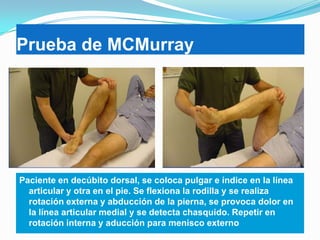 Prueba de MCMurray

Paciente en decúbito dorsal, se coloca pulgar e índice en la línea
articular y otra en el pie. Se flexiona la rodilla y se realiza
rotación externa y abducción de la pierna, se provoca dolor en
la línea articular medial y se detecta chasquido. Repetir en
rotación interna y aducción para menisco externo

 