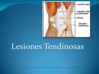 Lesiones Tendinosas

 