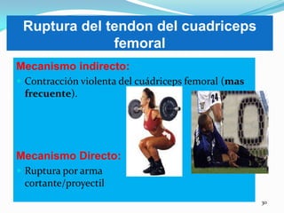 Ruptura del tendon del cuadriceps
femoral
Mecanismo indirecto:
 Contracción violenta del cuádriceps femoral (mas

frecuente).

Mecanismo Directo:
 Ruptura por arma

cortante/proyectil
30

 