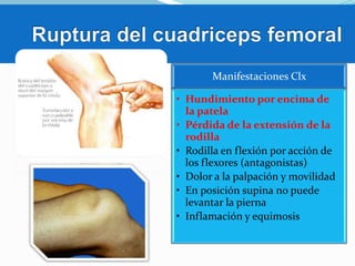 Manifestaciones Clx
• Hundimiento por encima de
la patela
• Pérdida de la extensión de la
rodilla
• Rodilla en flexión por acción de
los flexores (antagonistas)
• Dolor a la palpación y movilidad
• En posición supina no puede
levantar la pierna
• Inflamación y equimosis

 