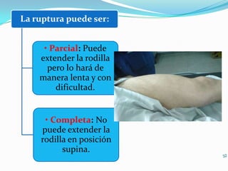La ruptura puede ser:
• Parcial: Puede
extender la rodilla
pero lo hará de
manera lenta y con
dificultad.

• Completa: No
puede extender la
rodilla en posición
supina.

 