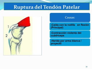 Ruptura del Tendón Patelar
Causas:
-Caída con la rodilla en flexión
(Principal)
-Contracción violenta del
cuádriceps
-Herida por arma blanca /
proyectil

34

 