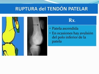 Rx.
• Patela ascendida
• En ocasiones hay avulsión
del polo inferior de la
patela

 