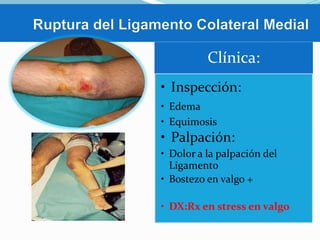 Clínica:
• Inspección:
• Edema
• Equimosis

• Palpación:
• Dolor a la palpación del
Ligamento
• Bostezo en valgo +
• DX:Rx en stress en valgo

 