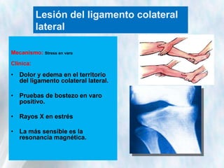 Lesión del ligamento colateral
lateral
Mecanismo: Stress en varo
Clínica:

• Dolor y edema en el territorio
del ligamento colateral lateral.
• Pruebas de bostezo en varo
positivo.
• Rayos X en estrés
• La más sensible es la
resonancia magnética.

 