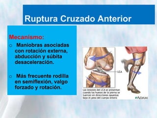 Ruptura Cruzado Anterior
Mecanismo:
o Maniobras asociadas
con rotación externa,
abducción y súbita
desaceleración.
o Más frecuente rodilla
en semiflexión, valgo
forzado y rotación.

 