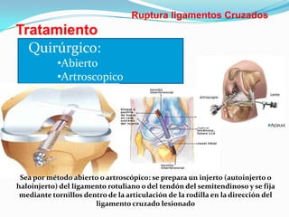 Ruptura ligamentos Cruzados

Tratamiento
Quirúrgico:
•Abierto
•Artroscopico

Sea por método abierto o artroscópico: se prepara un injerto (autoinjerto o
haloinjerto) del ligamento rotuliano o del tendón del semitendinoso y se fija
mediante tornillos dentro de la articulación de la rodilla en la dirección del
ligamento cruzado lesionado

 