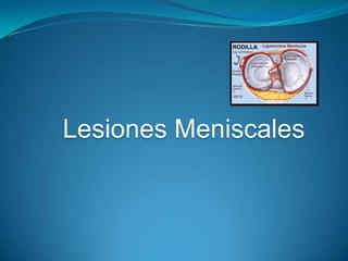 Lesiones Meniscales

 