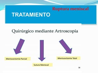 Ruptura meniscal

TRATAMIENTO

 