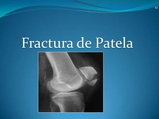 Fractura de Patela

 