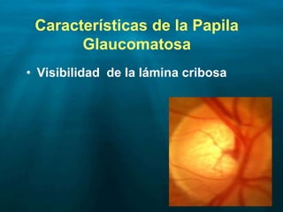 Características de la Papila
Glaucomatosa
• Visibilidad de la lámina cribosa
 