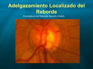 Adelgazamiento Localizado del
Reborde
Escotadura del Reborde Neural o Notch
 