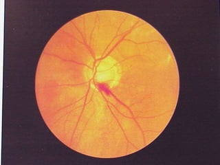 G. Crónico ángulo abierto
 