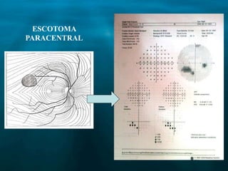 ESCOTOMA
PARACENTRAL
 