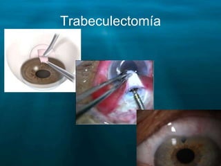 Trabeculectomía
 