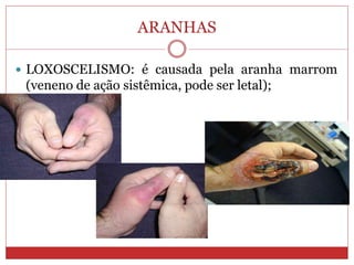ARANHAS
 LOXOSCELISMO: é causada pela aranha marrom
(veneno de ação sistêmica, pode ser letal);
 